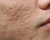 Image result for Acne Scars Men