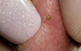 Image result for Pop Pimple Popping