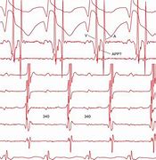 Image result for Atrioventricular Reciprocating Tachycardia