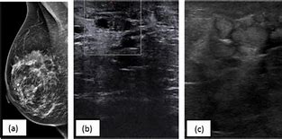 Image result for Retrocaval Cyst