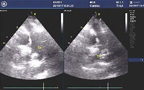 Image result for Atrleft Atrail Appendage Thrombus