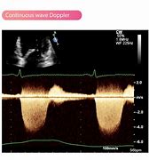 Image result for Continuous Wave Doppler Ultrasound