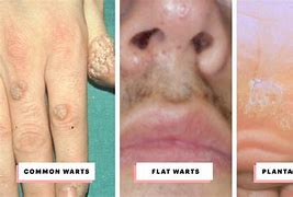 Image result for Plane Warts