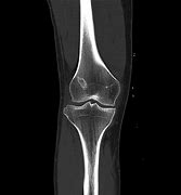 Image result for CT Knee Point Graph