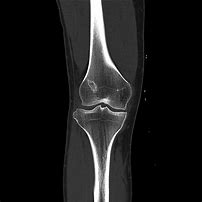 Image result for CT Knee Radiopaedia