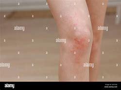 Image result for Allergic Reaction with Pustules