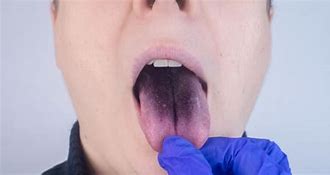 Image result for Blood Spots Under Tongue