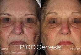 Image result for Post Pico Genesis Histamine Reaction