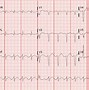 Image result for Atrioventricular Reciprocating Tachycardia