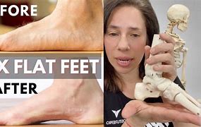 Image result for Flat Feet