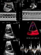 Image result for Right Atrial Appendage Fetal Echo