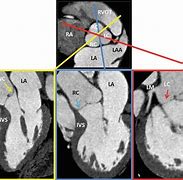 Image result for Anatomical Site of Left Ventricular Outflow Tract