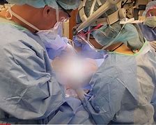 Image result for Cancer Surgery