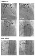 Image result for Coronary Angiography Catheters