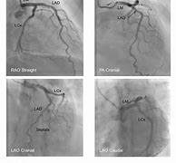 Image result for Coronary Artery Angiography