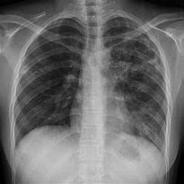 Image result for Chest X-ray of TB