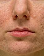 Image result for Atrophic Scar Treatment