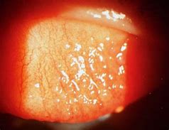 Image result for Tarsal Conjunctiva Papillae