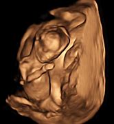 Image result for 4D Ultrasound at 15 Weeks