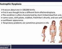 Image result for Pseudo Dwarfism