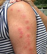 Image result for Bed Bug Bites Groin