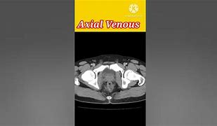 Image result for Retrocaval Surter Radiology