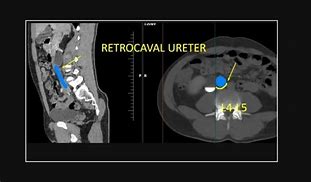 Image result for Retrocaval Ureter X-ray