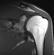 Image result for Shoulder MRI