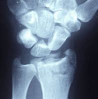 Image result for Radius Fracture