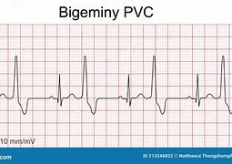 Image result for Bigeminy PVC ECG