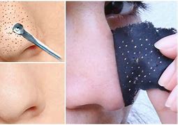 Image result for Skin Peels Blackhead Removal