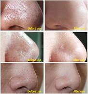 Image result for Blackhead Removal Peel Off Mask