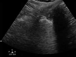 Image result for Pulmonary Regurg Ultrasound Flame