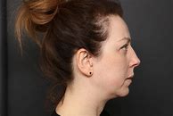 Image result for Recessed Chin Surgery