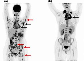 Image result for Pet Scan Lymphoma Example