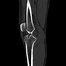 Image result for CT Knee Radiopaedia