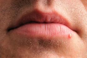 Image result for Pustule Pimple