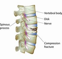 Image result for Lumbar Compression Burst Fractures