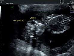 Image result for Anencephaly Ultrasound