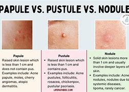 Image result for Pustule Skin Lesion