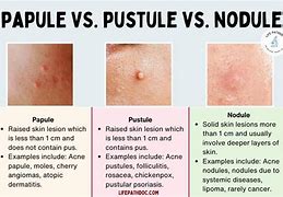 Image result for Pustule Rashes