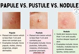 Image result for Pustule Pimple