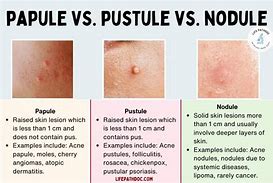 Image result for Papule Pimple