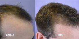 Image result for Low Dose Minoxidil for Hair Loss