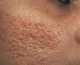 Image result for Atrophic Scar Treatment