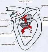 Image result for Complete Atrioventricuar Canal