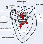 Image result for Complete Atrioventricular Canal Defect