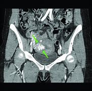 Image result for CT Angiogram Abdomen