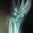 Image result for Radius Fracture