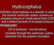 Image result for Hydrocephalus